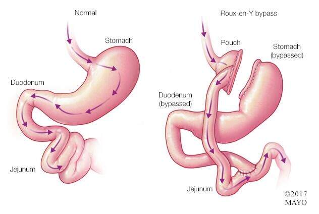 Gastric bypass surgery