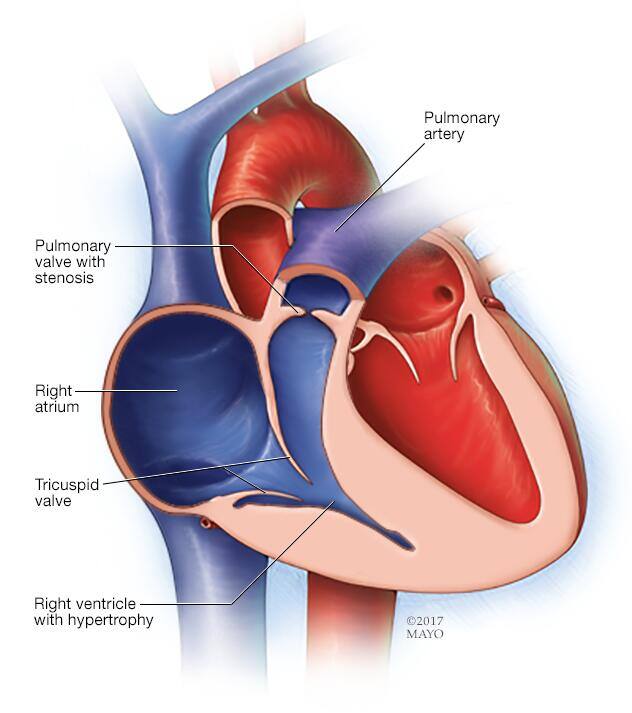 Pulmonary stenosis