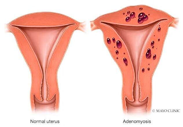 Normal uterus vs. uterus with adenomyosis