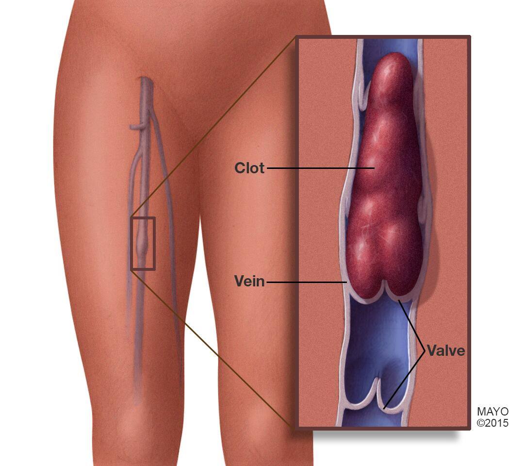 Blood clot in leg vein