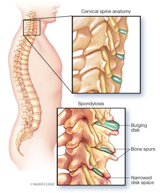 Cervical spondylosis