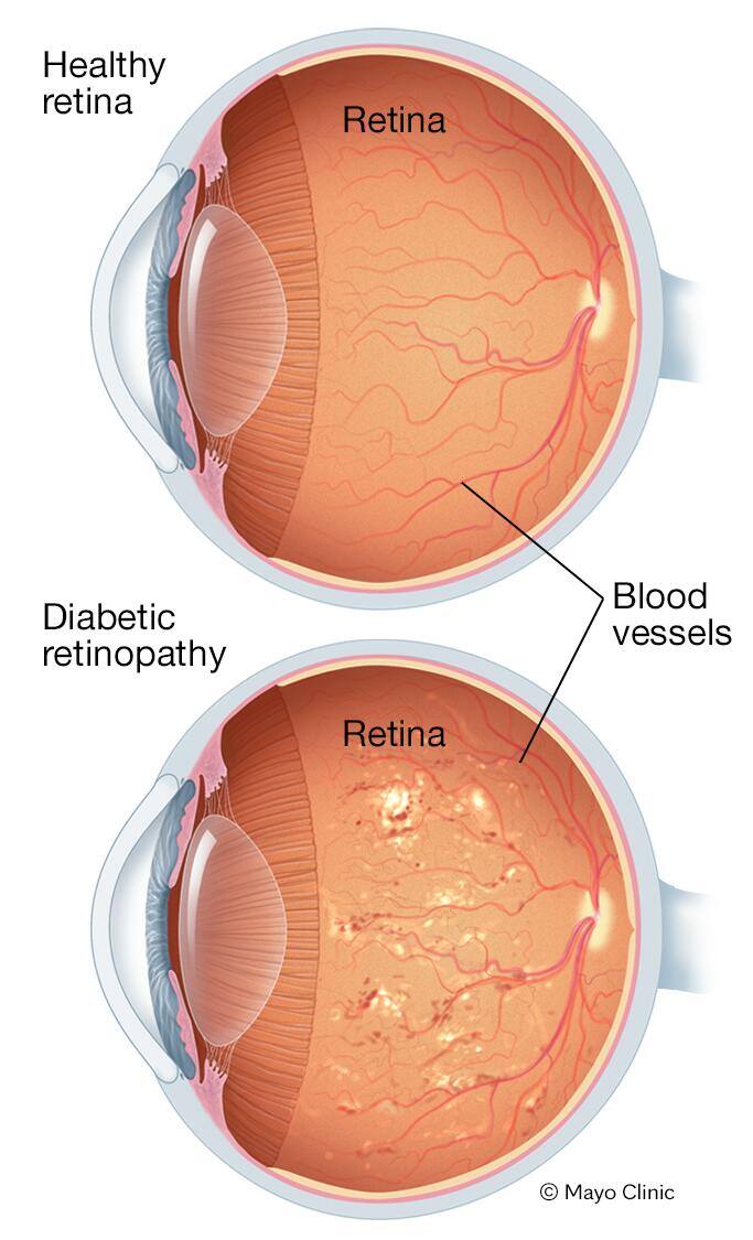 Severe nonproliferative diabetic retinopathy