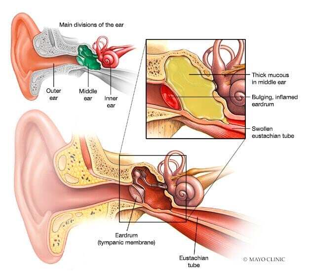 Ear infection