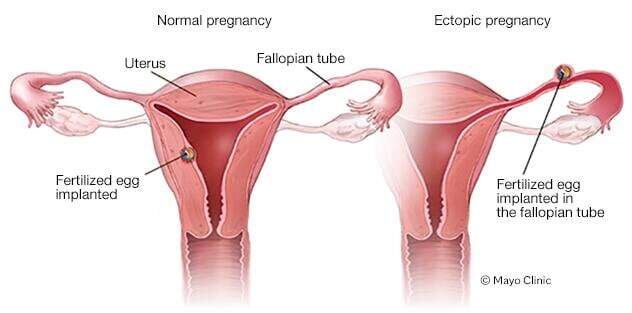 Normal vs. ectopic pregnancy