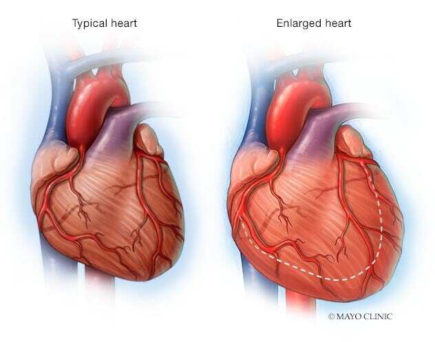 An enlarged heart