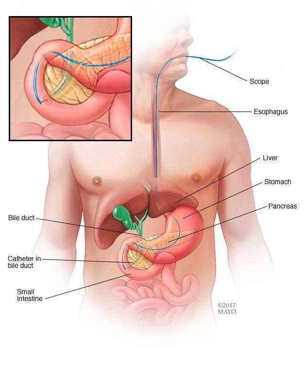 ERCP procedure