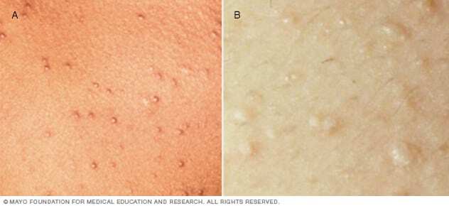 Two types of heat rash