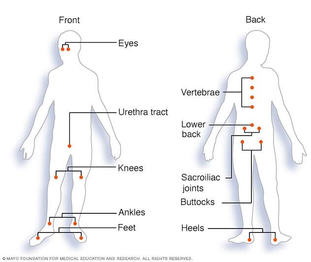 Common inflammation sites in reactive arthritis