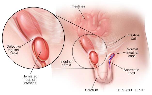 Inguinal hernia