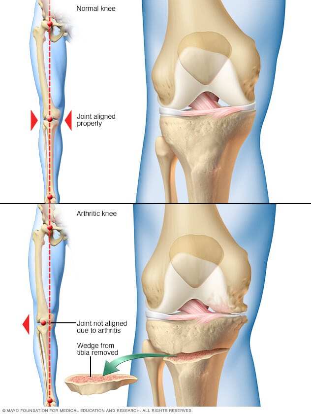 Knee osteotomy