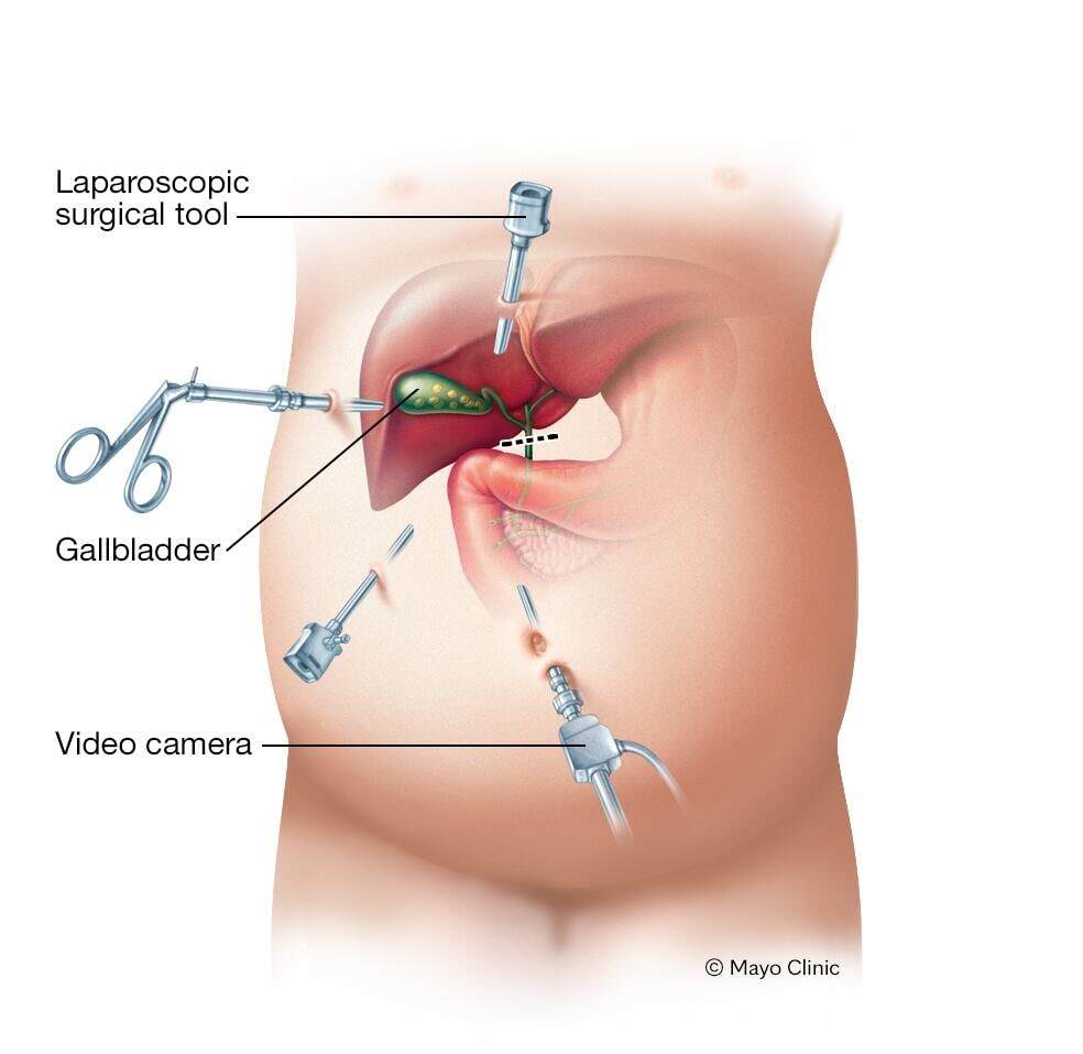 Laparoscopic cholecystectomy