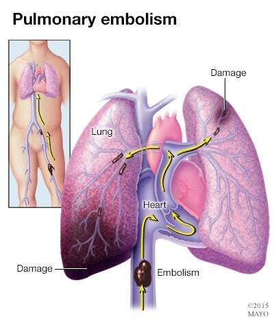 Pulmonary embolism