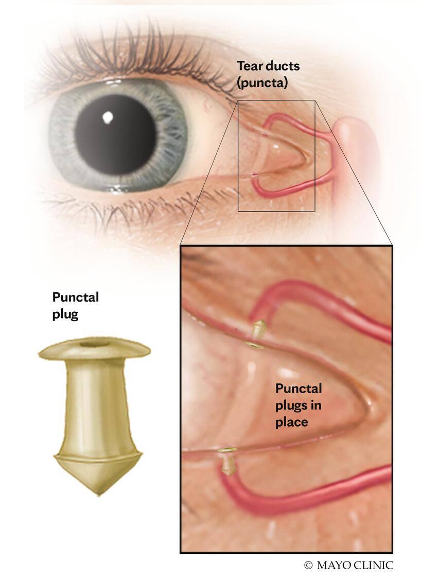 Punctal plugs