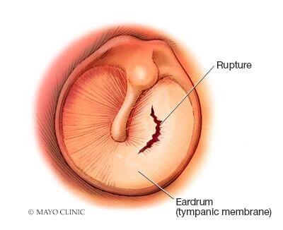 Eardrum showing rupture 