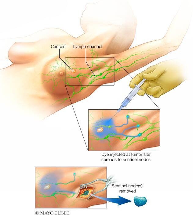 Sentinel node biopsy