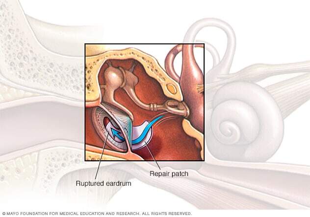 Tympanoplasty