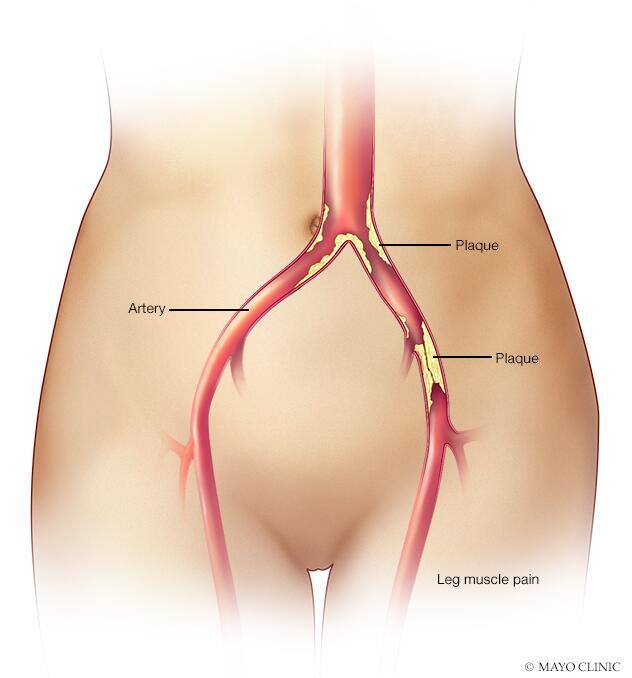 Claudication