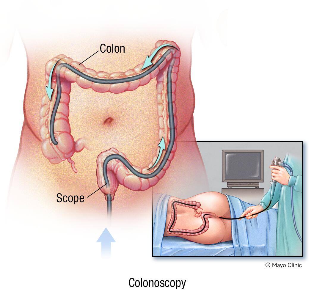 Colonoscopy exam