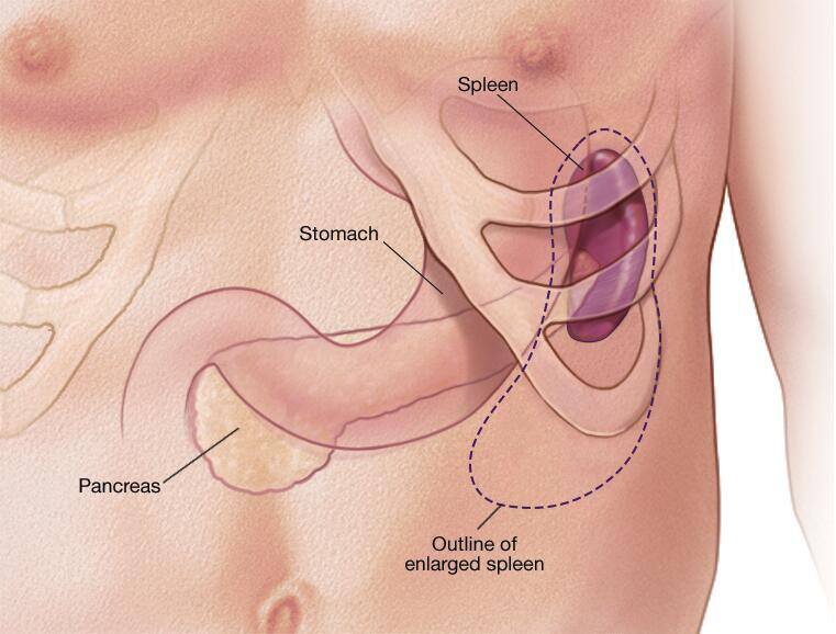 Enlarged spleen