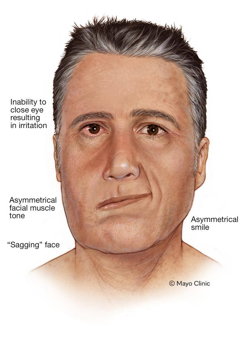 Facial paralysis