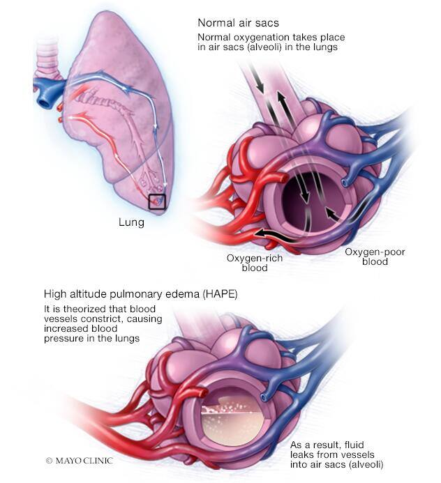 High-altitude pulmonary edema