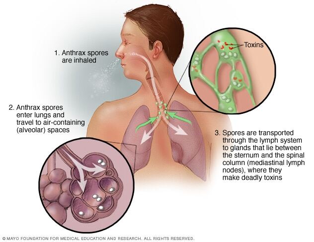 Inhalation anthrax