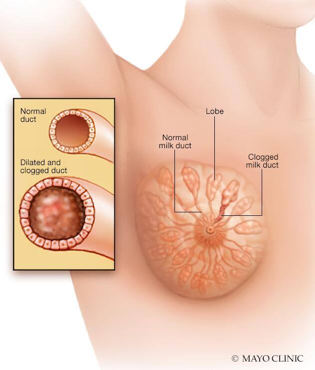 Clogged milk duct in mammary duct ectasia