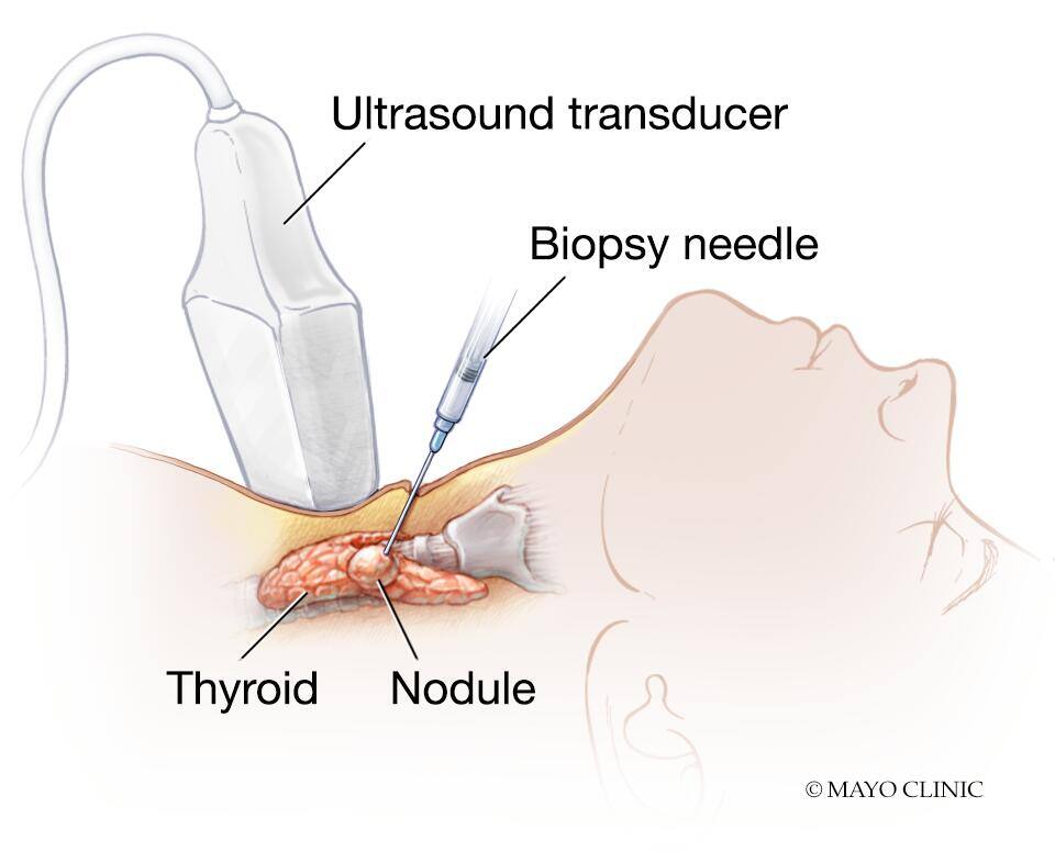 Needle biopsy of thyroid cancer 