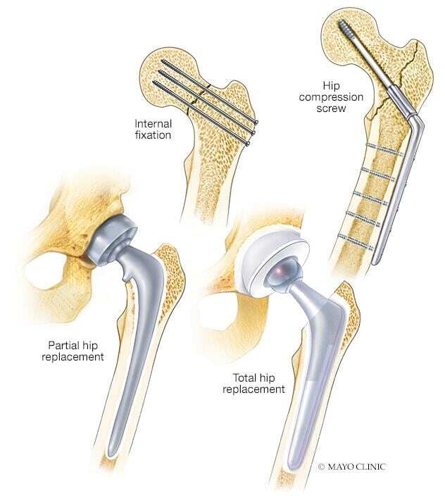 Hip fracture repair techniques