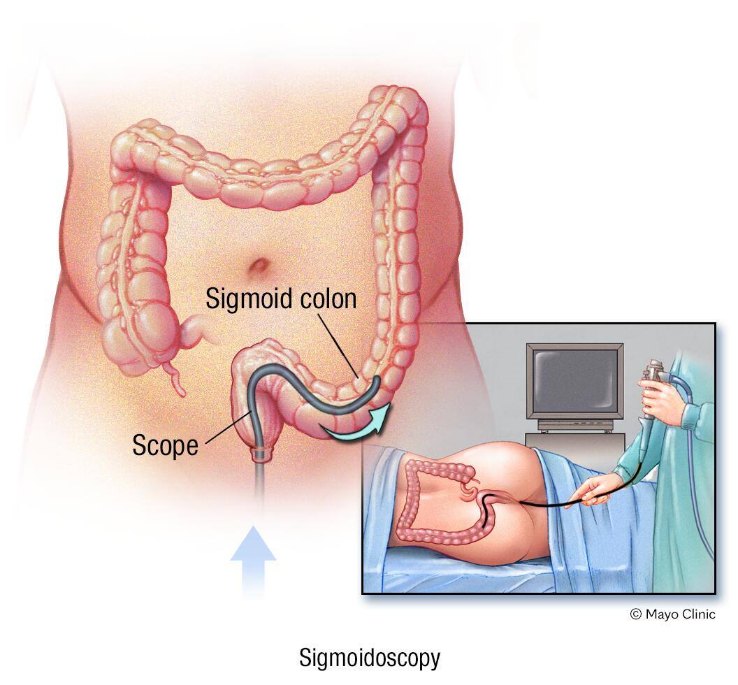 Flexible sigmoidoscopy exam