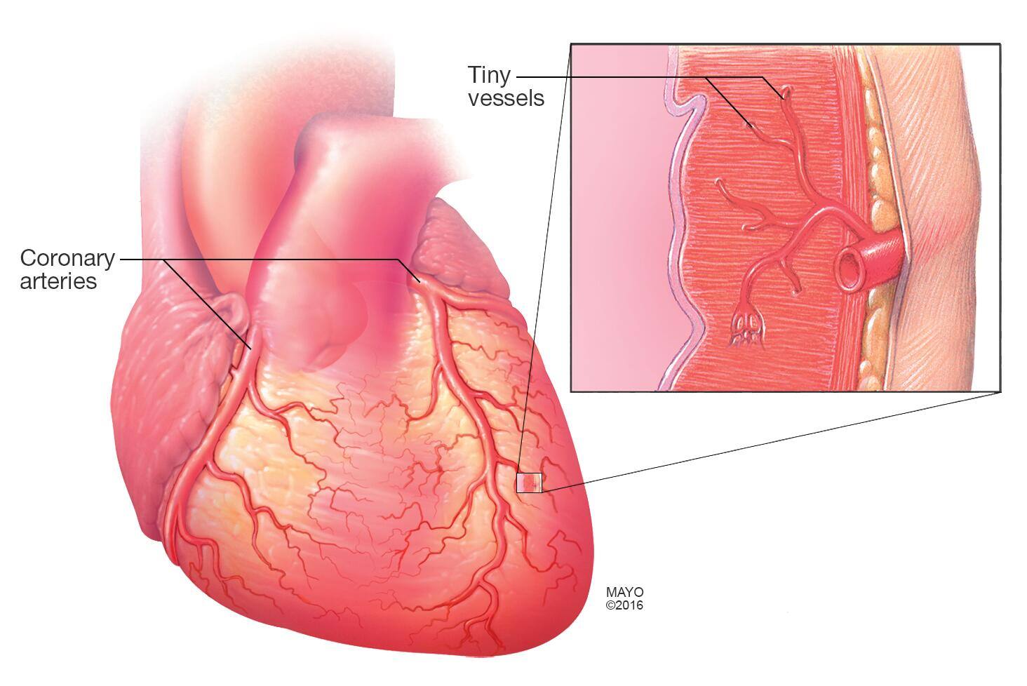 Small vessel disease