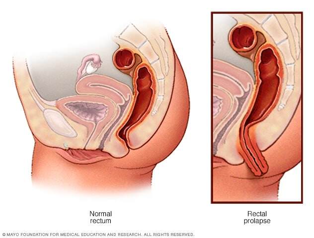 Normal rectum and rectal prolapse