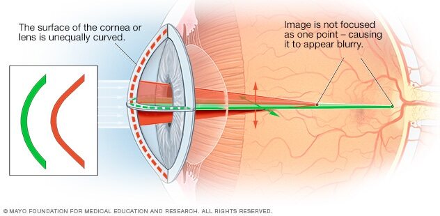 Astigmatism