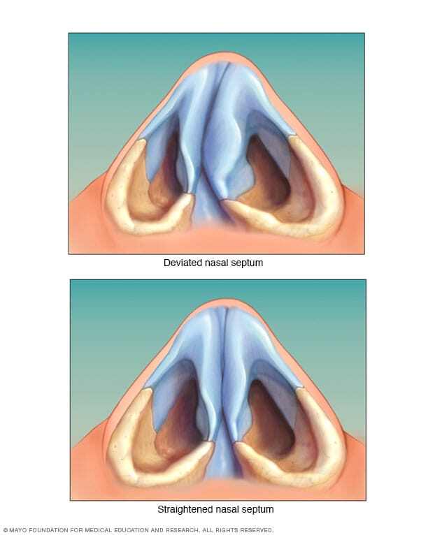 Deviated septum