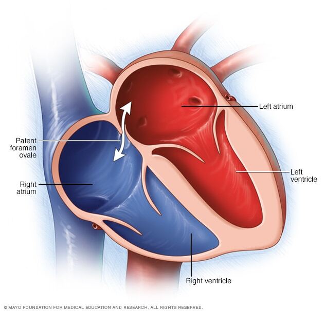 Patent foramen ovale