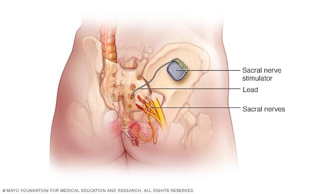 Sacral nerve stimulation device