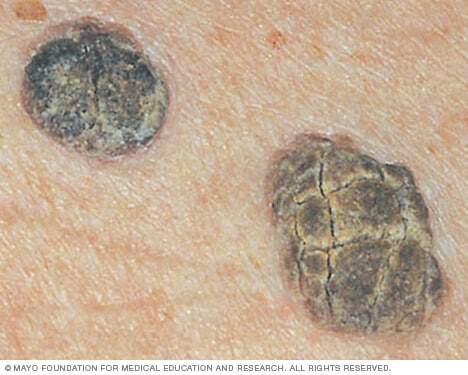 Close-up image of seborrheic keratoses 