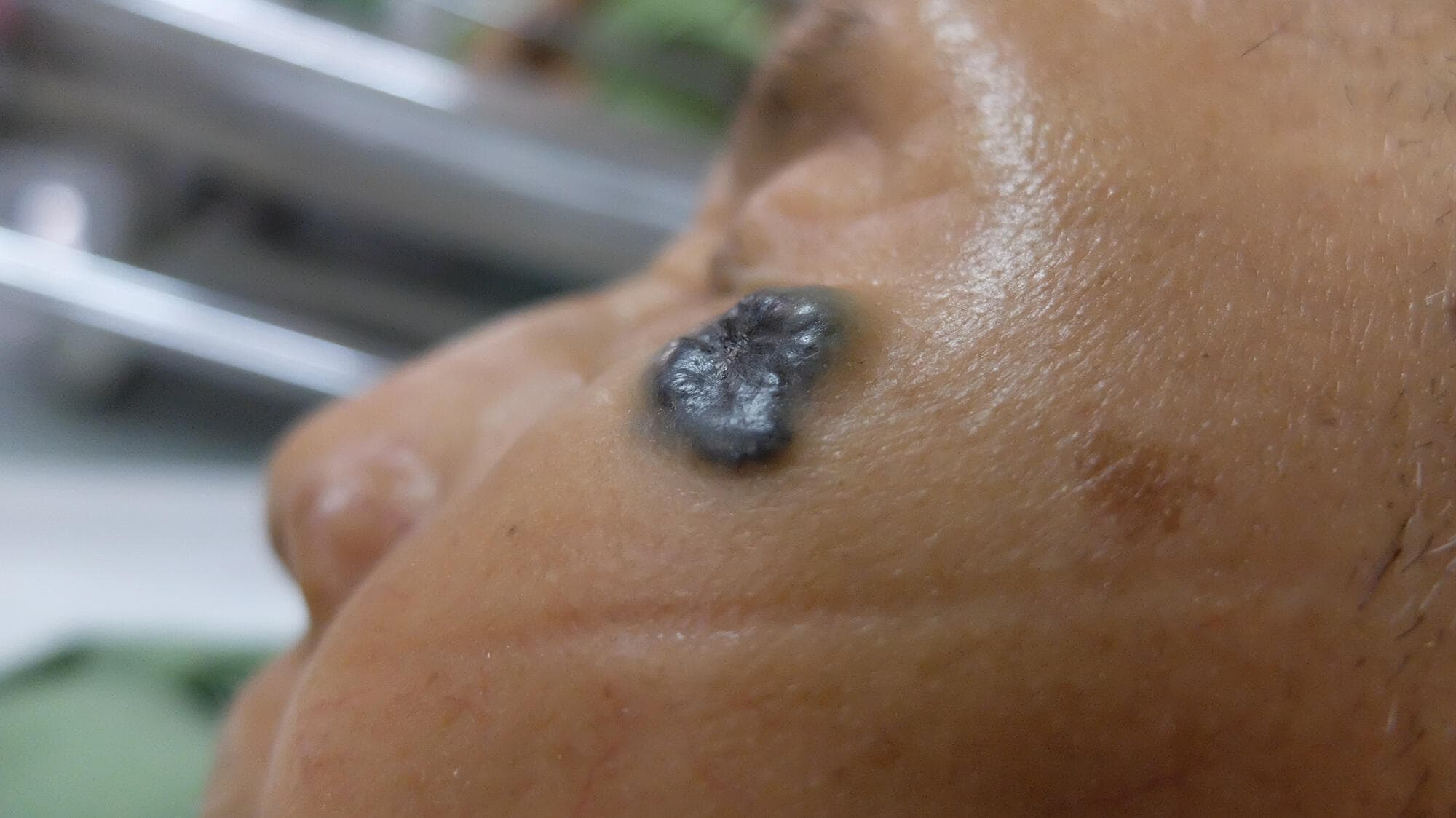 Basal cell carcinoma on brown skin