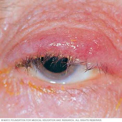 Blepharitis 