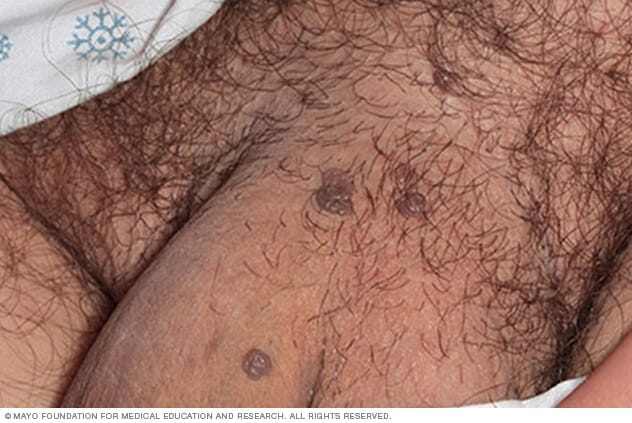 Male genital warts