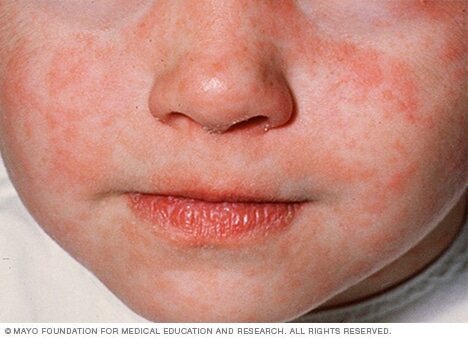 Measles rash 