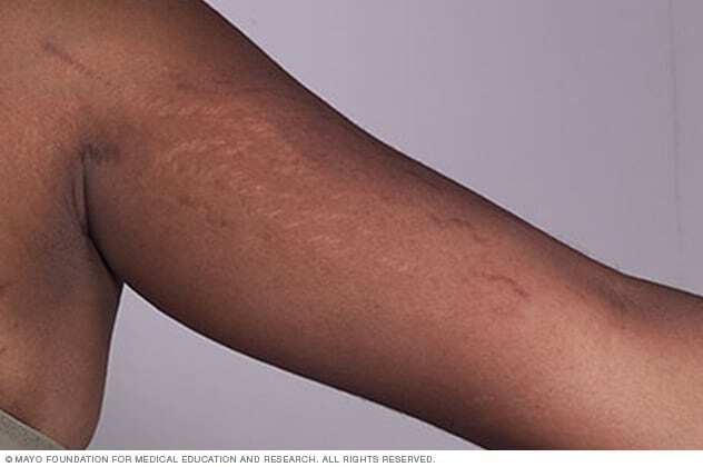 Stretch marks on arm