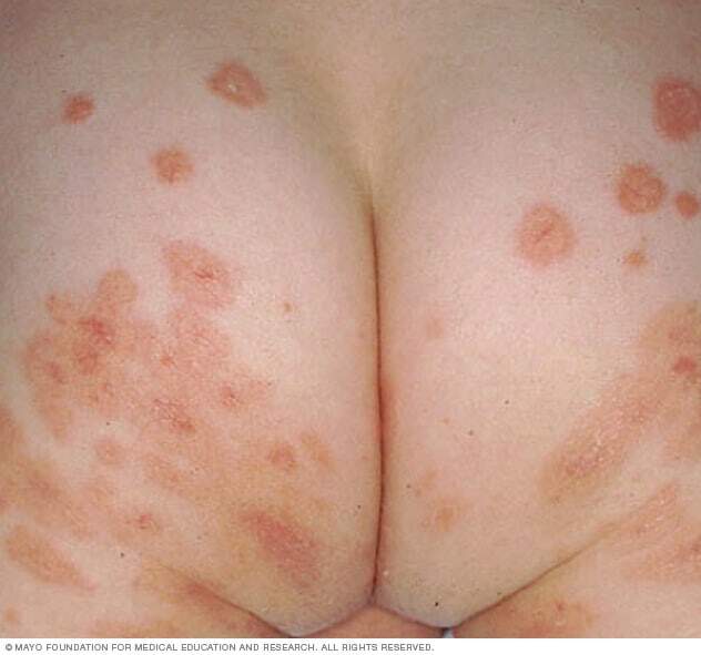 Bullous impetigo sores