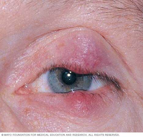 A chalazion