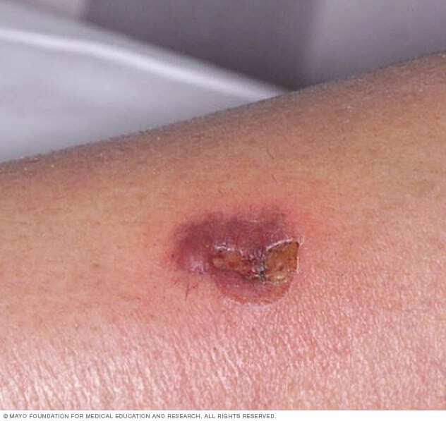 An ecthyma sore