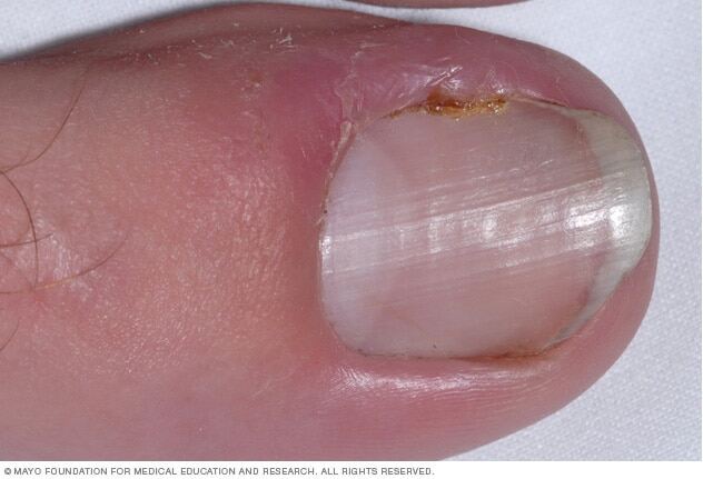 An ingrown toenail