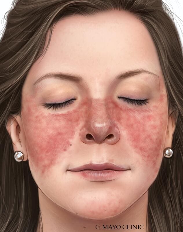 Illustration showing red, butterfly-shaped rash on nose and cheeks