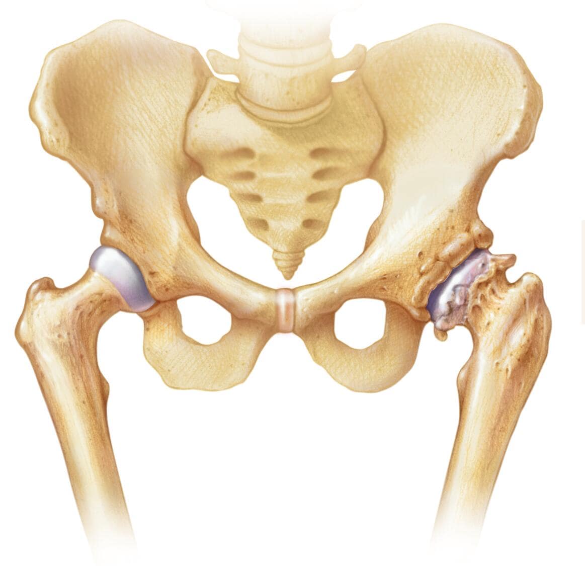 Osteoarthritis of the hip