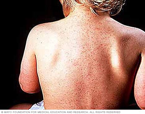 Roseola rash