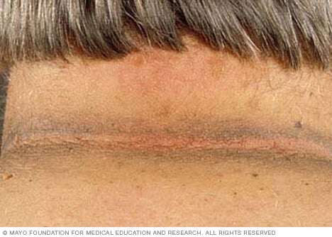  Photo of acanthosis nigricans